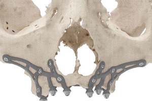 Implantologia iuxta ossea 1